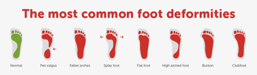 Happy Feet: How to Recognize and Treat Foot Misalignments – haflingerUSA