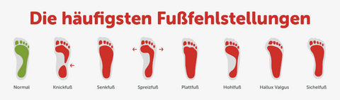 Recognizing and Treating Foot Misalignments